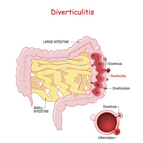 diverticulitis diagram|symptoms of diverticulosis large intestine.